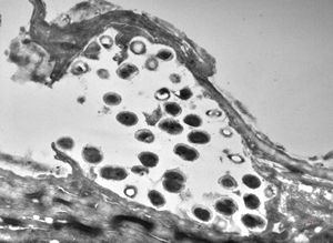 M,68y. | auditory meatus … otitis externa mycotica M,68y. | auditory meatus … otitis externa mycotica